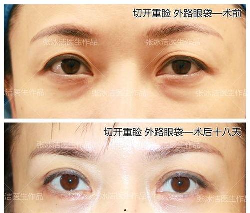 祛眼袋手术视频,专业视频带你了解眼部年轻化技巧
